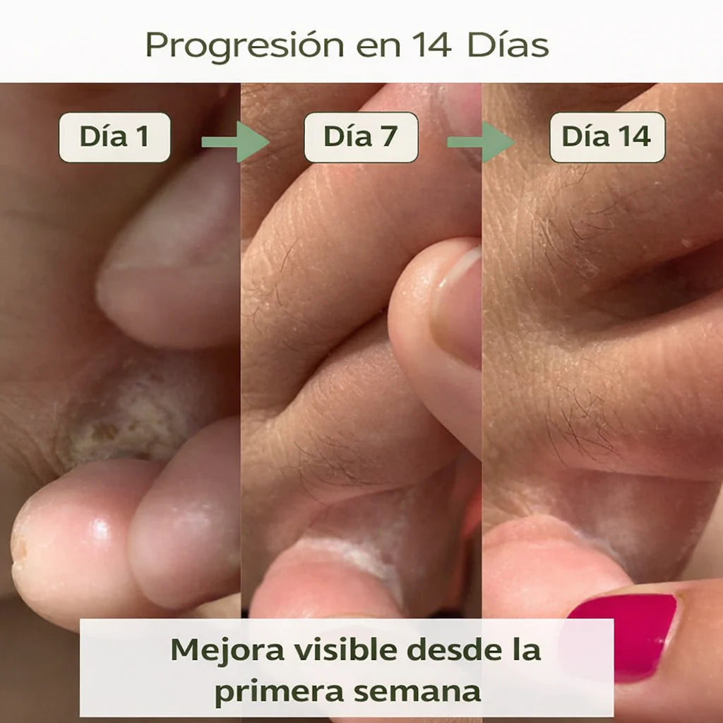 Vertmeé - Jabón Purificante Antimicótico